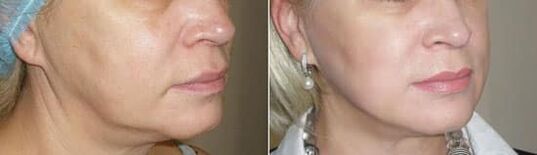 Foto despois da aplicación do procedemento