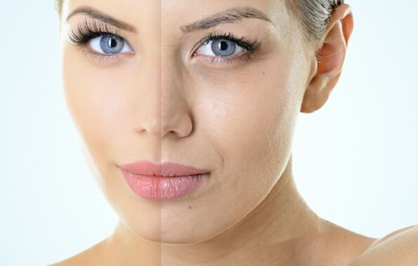 Indicacións para o rexuvenecemento fraccionado