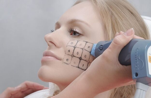 Procedemento de termaxe