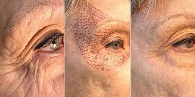 Fotos antes e despois do rexuvenecemento da pel con plasma